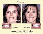 Zahnbehandlung in CZ - Implantate ab Euro 490